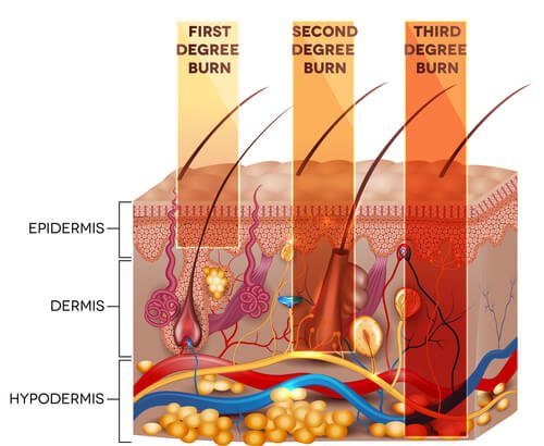 types of burn injuries